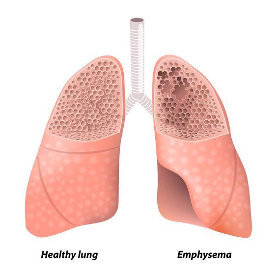 Emphysema: Causes, Symptoms, Diagnosis and Treatment